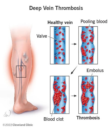 Bedside Diagnosis of Deep Vein Thrombosis Using a Pocket-Sized Ultrasound  Device - The American Journal of Medicine