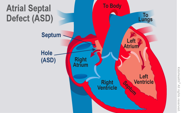 Mengenal Atrial Septal Defect (ASD)