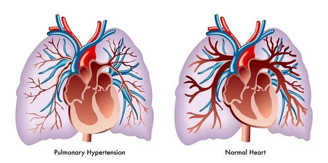 Mengenal Hipertensi Paru pada Penyakit Jantung Bawaan