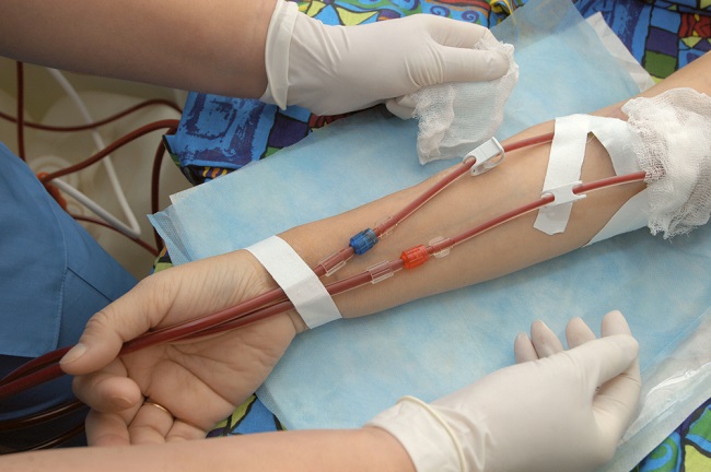 Akses Vaskular Cimino (Arteriovenous) Fistula bagi Pasien yang Menjalani Hemodialisis
