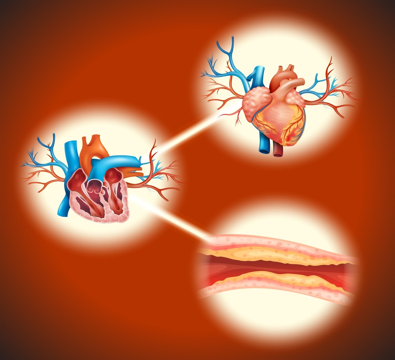 Penanganan Penyakit Jantung Koroner: Operasi atau PCI?